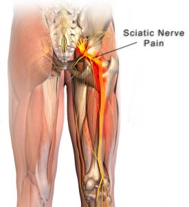 Sciatica Massage for Pain Relief